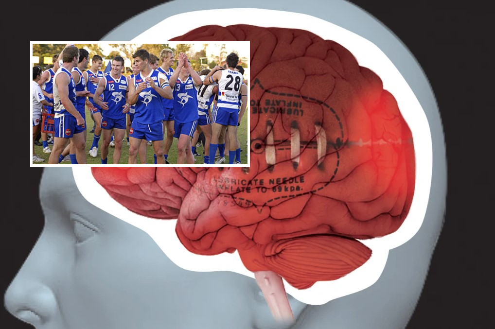 Article image for Bringing awareness to CTE after WAFL player robbed of his life