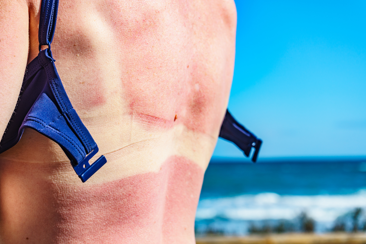 Article image for The harsh reality of getting burnt under the Australian sun