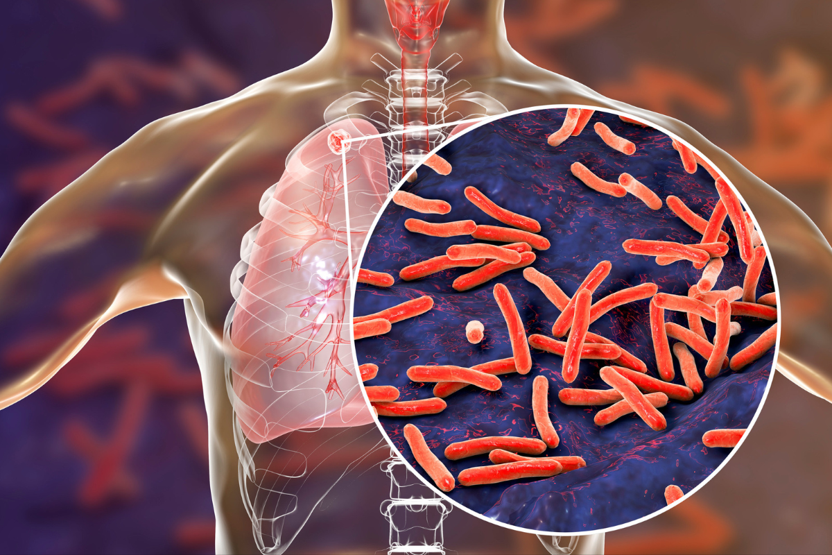 Article image for Climb in tuberculosis cases puts sector on high alert