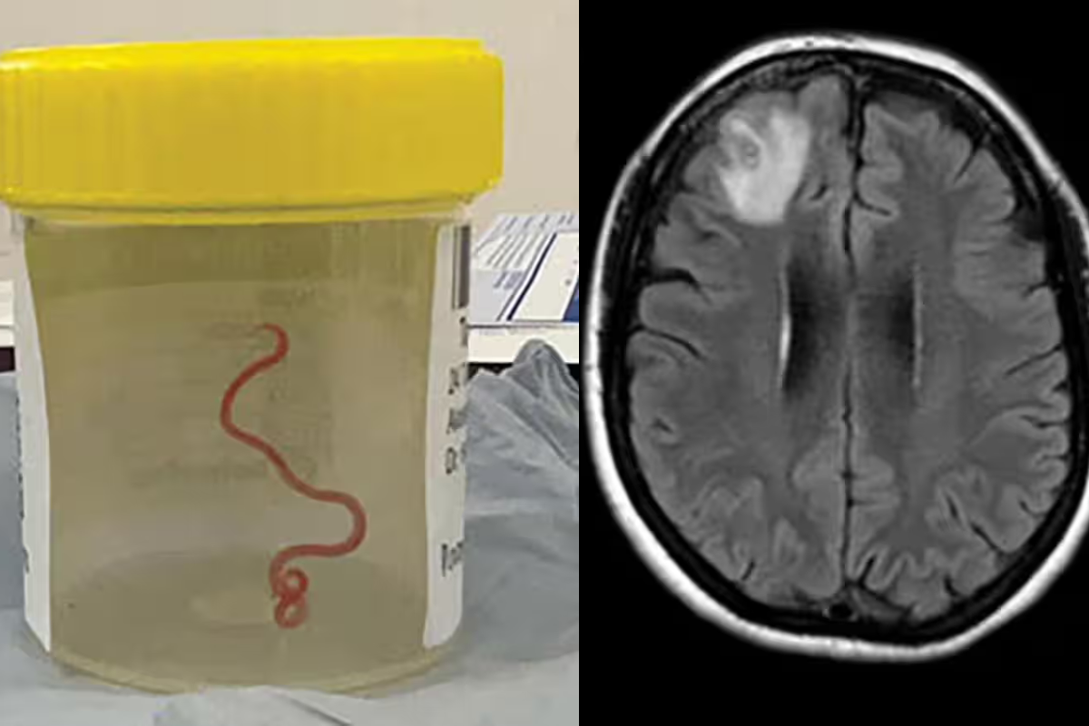 Article image for Huge roundworm removed from woman’s brain the first case of its kind