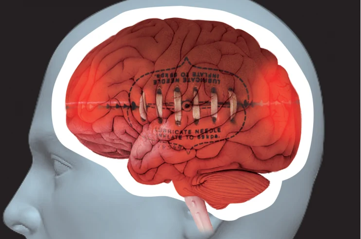 Article image for Research questions the link between head knocks and CTE